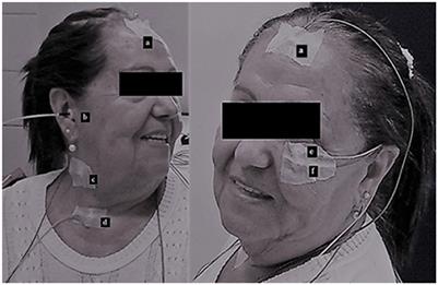 Vestibular Evoked Myogenic Potential on Ocular, Cervical, and Soleus Muscles to Assess the Extent of Neurological Impairment in HTLV-1 Infection